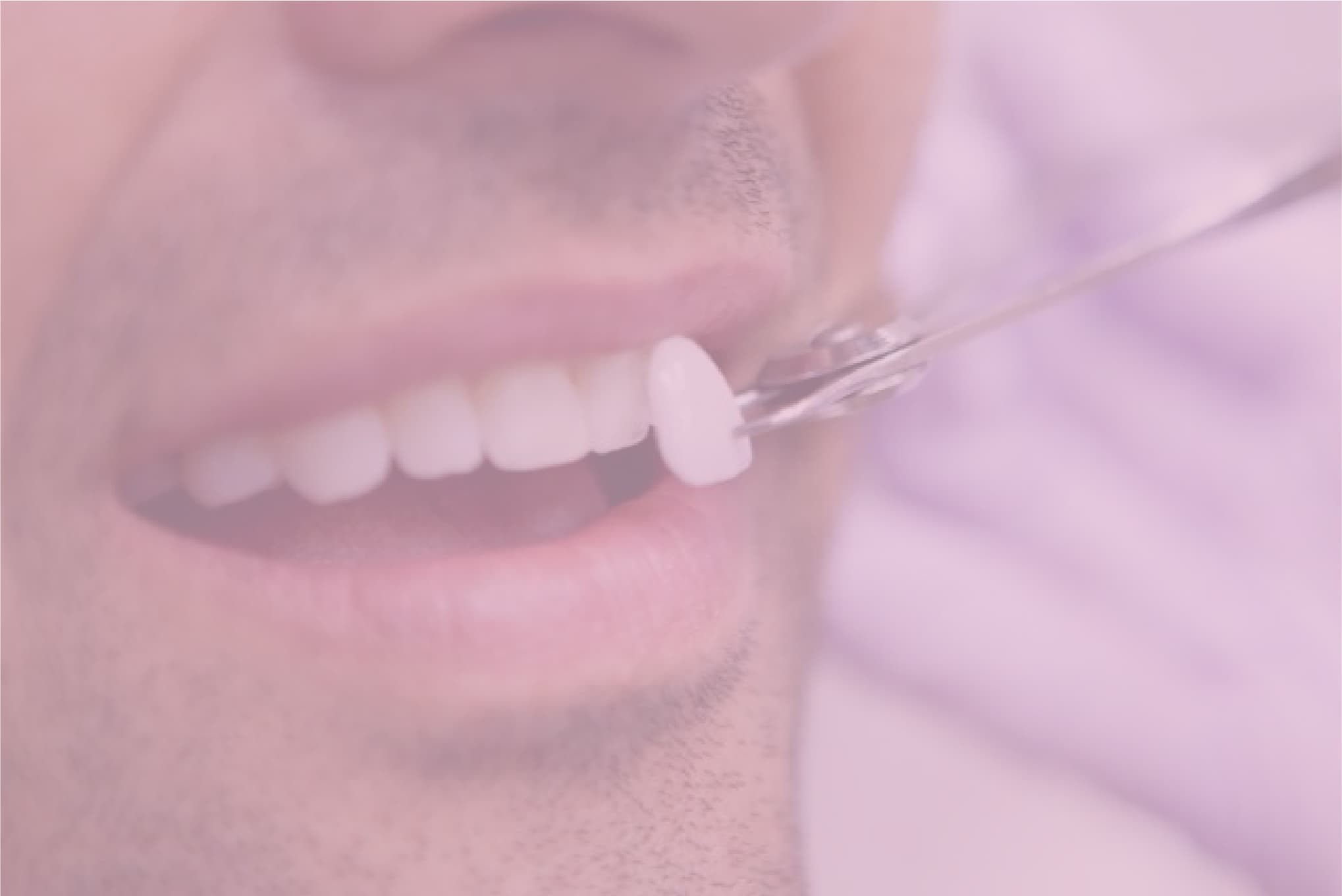 Understanding the Dental Veneer Procedure: A Step-by-Step Guide