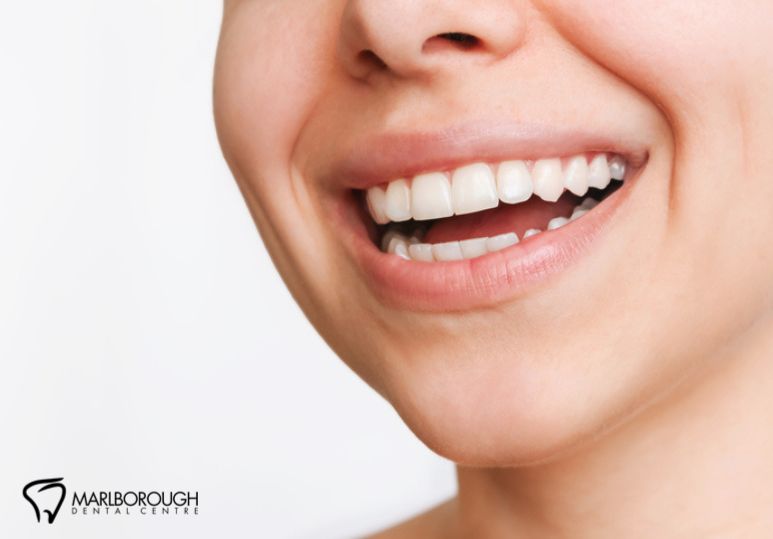 Veneer Maintenance: Tips for Keeping Your Smile Bright