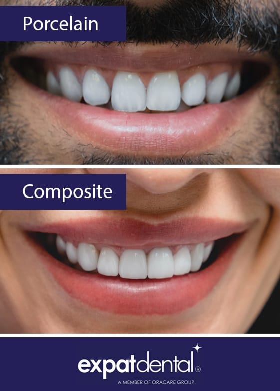 Pros and Cons of Porcelain vs. Composite Dental Veneers