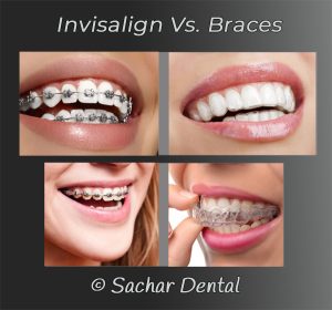 Invisalign vs. Traditional Braces: A Detailed Comparison
