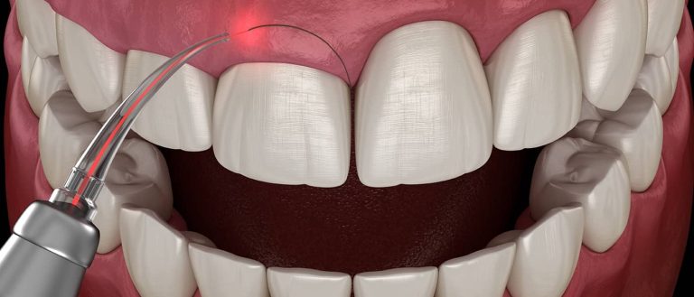 Post-Treatment Care for Gum Surgery